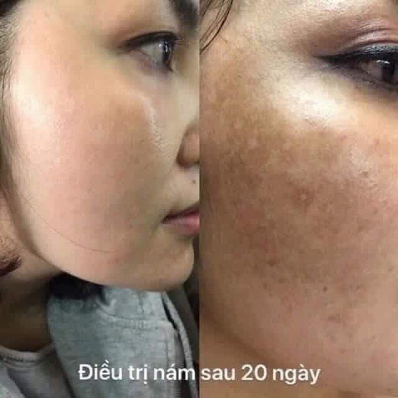 Bột Đánh Nám Tàn Nhang (gồm 2 bột và 1 lọ collagen đặc) | BigBuy360 - bigbuy360.vn