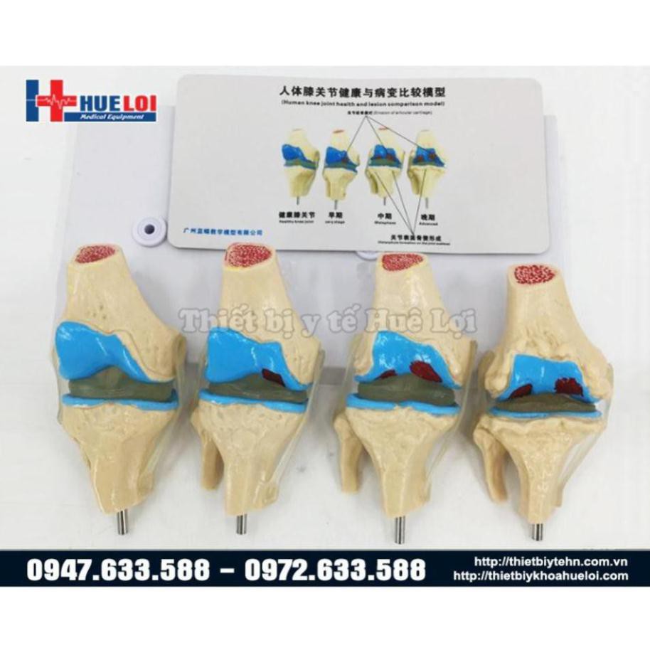Mô hình bệnh lý khớp gối