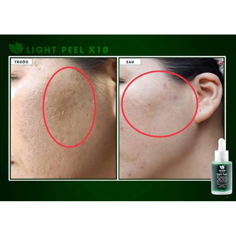 PEEL DA GIẢM NÁM, GIẢM MỤN, TRẺ HÓA DA[CHÍNH HÃNG] | BigBuy360 - bigbuy360.vn