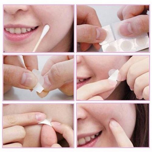 Hộp 12 miếng dán mụn Acnes Clear Patch - ngừa thâm mụn hiệu quả