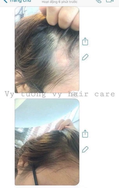 Combo ngăn rụng kích mọc tóc VyvyHairCare