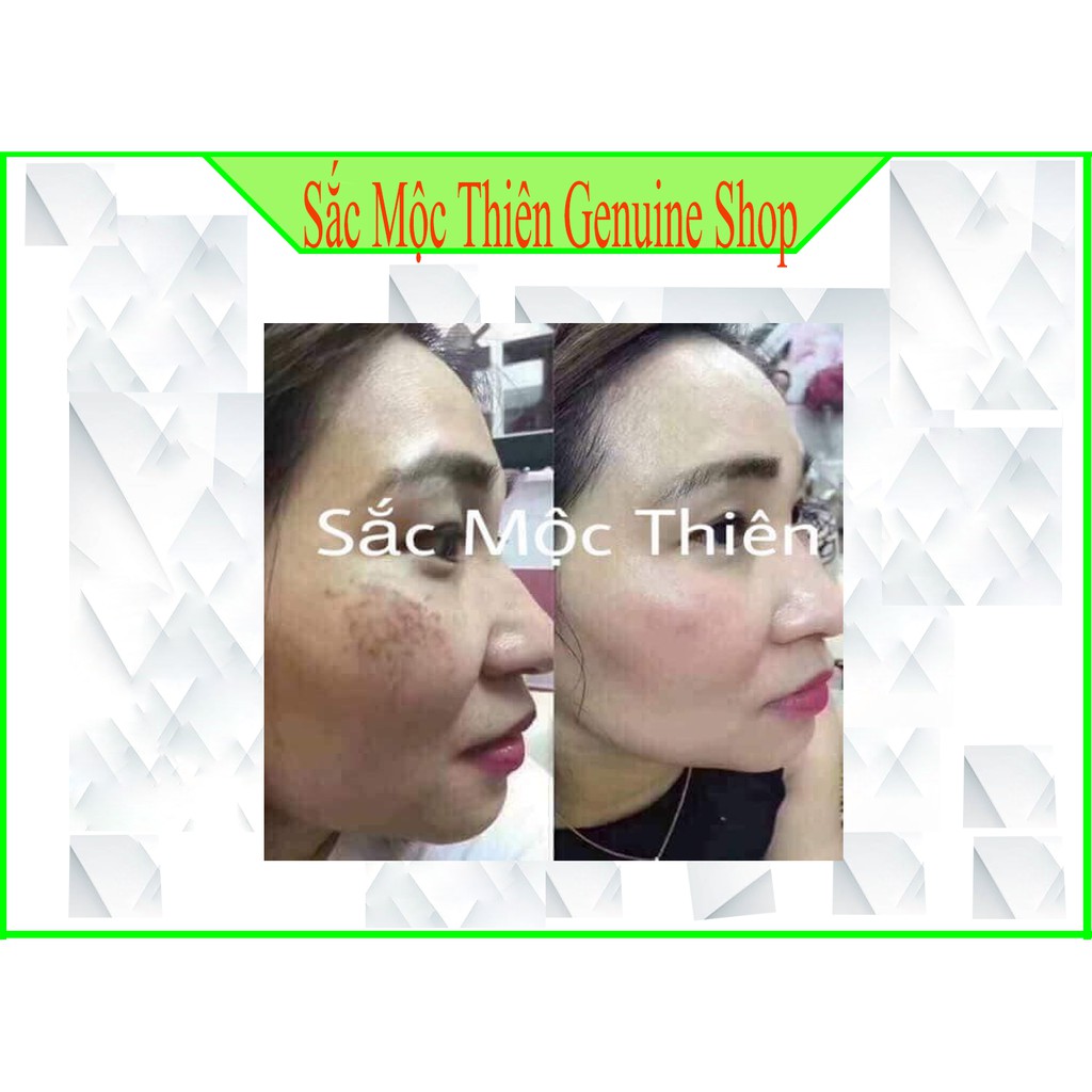 Tái Tạo Sắc Mộc Thiên -Làm bay  mụn , nám , tàn nhang- Cam kết hoàn tiền 100% nếu không hiệu quả . | BigBuy360 - bigbuy360.vn