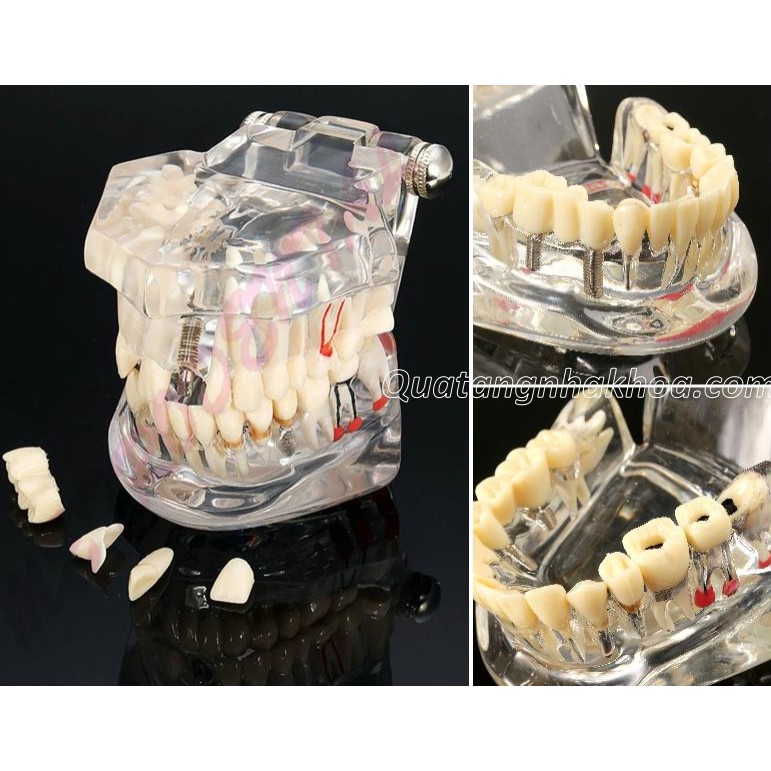 Mẫu hàm tư vấn bệnh lý - cầu răng - Implant trong nha khoa  - Mô hình răng nha khoa