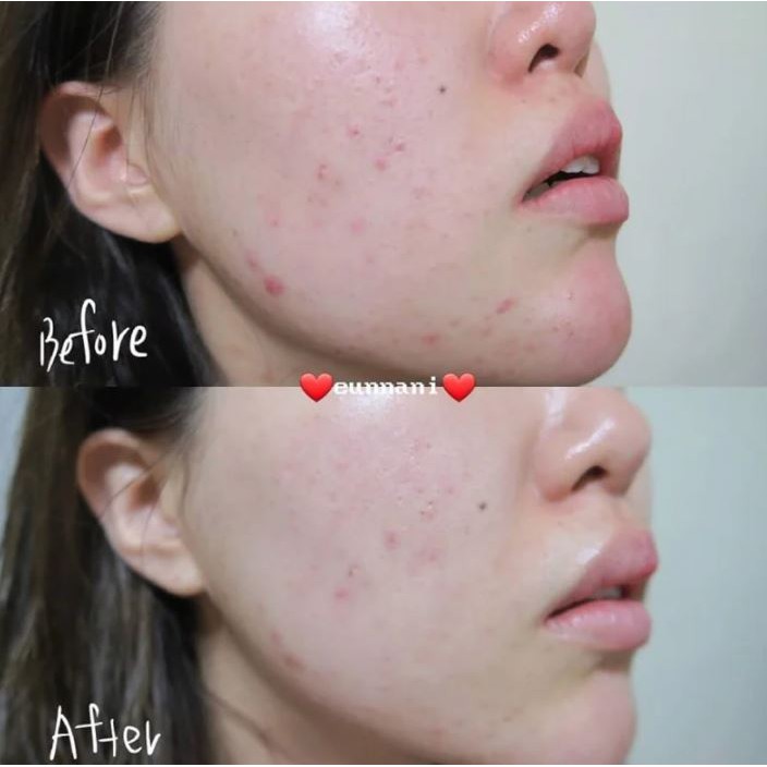 Kem Dưỡng Kiểm Soát Dầu Eucerin Acne-Oil Control Pro Acne Solution A.I Matt Fluid 50ml