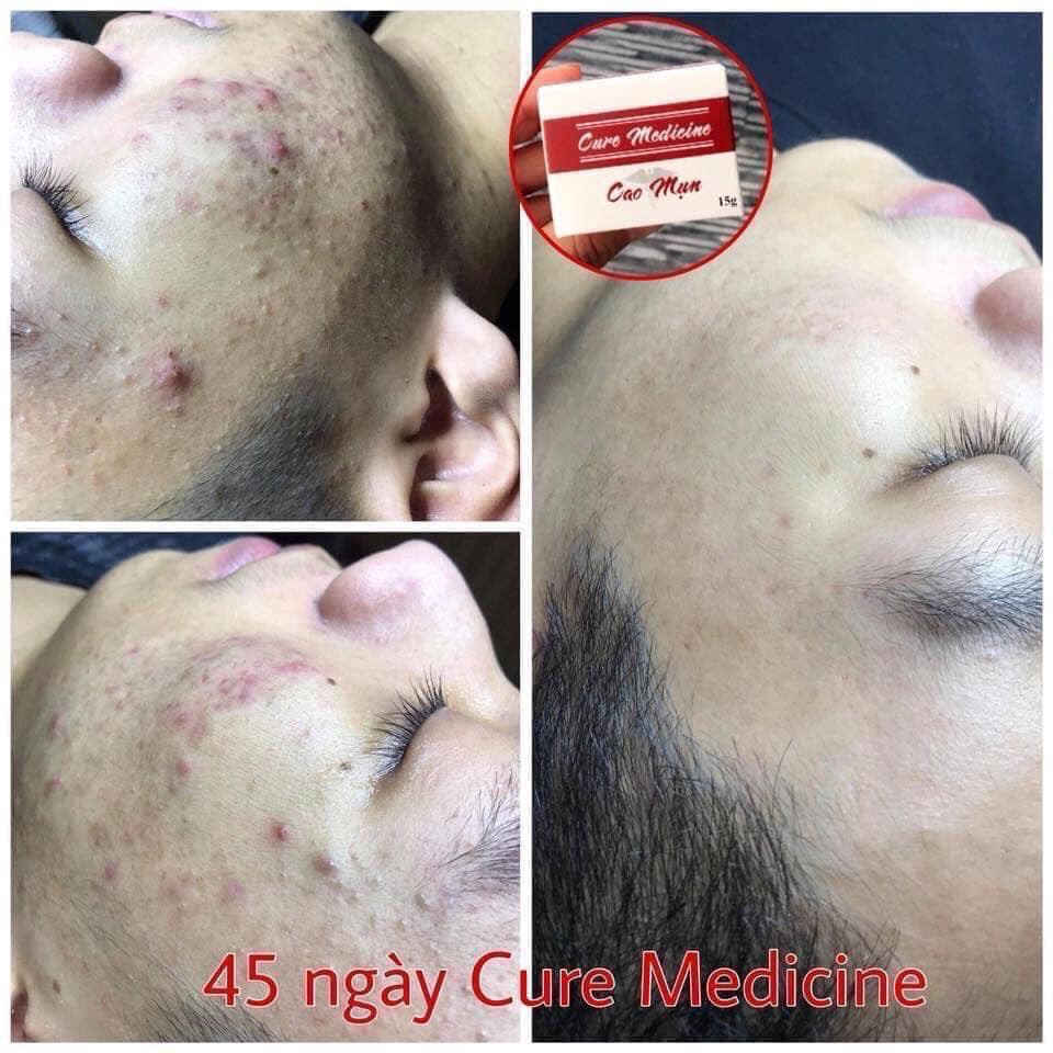 Cure medicine cao mụn