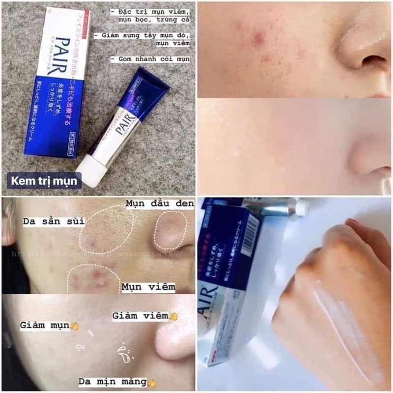 THANH LÝ‼️Kem hỗ trợ hết mụn Pair Acne W Cream Nhật Bản 24gr - Logod.r