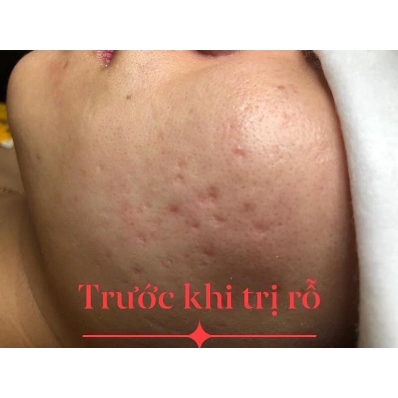 Kem tái tạo da mụn nám | BigBuy360 - bigbuy360.vn