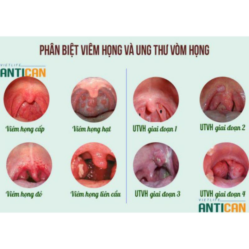 Ho, amidan, viêm họng hạt ông cụ làng nghè