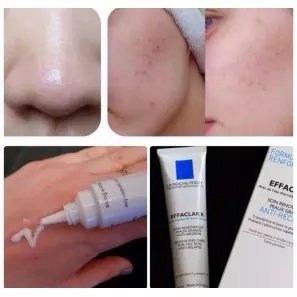 Kem dưỡng giảm mụn, ngăn ngừa vết thâm và ngăn mụn tái phát La Roche-Posay Effaclar Duo+ 40ml