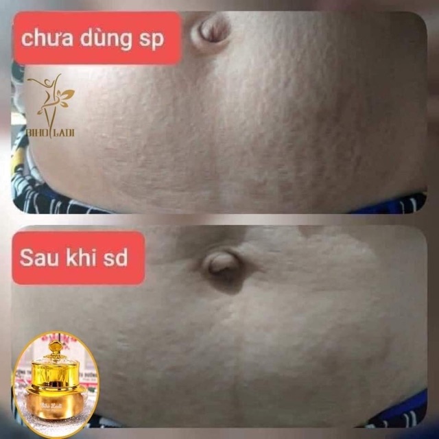 [Mua 1 tặng 1] Siêu Dưỡng thâm 5S BIHO LADI | BigBuy360 - bigbuy360.vn