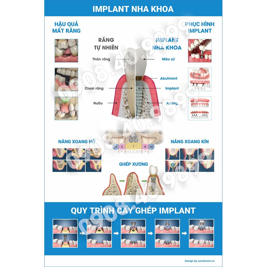Tranh nha khoa "Implant Nha khoa"