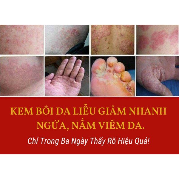 Kem bôi da liễu, dứt điểm ghẻ lở, ghẻ nước, nấm da, hắc lào Đông y gia truyền Thông Cát HIỆU QUẢ SAU 3 LẦN SỬ DỤNG