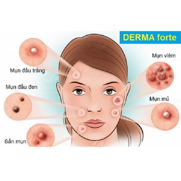 Kem ngừa Mụn ,giảm thâm Derma Forte 15G