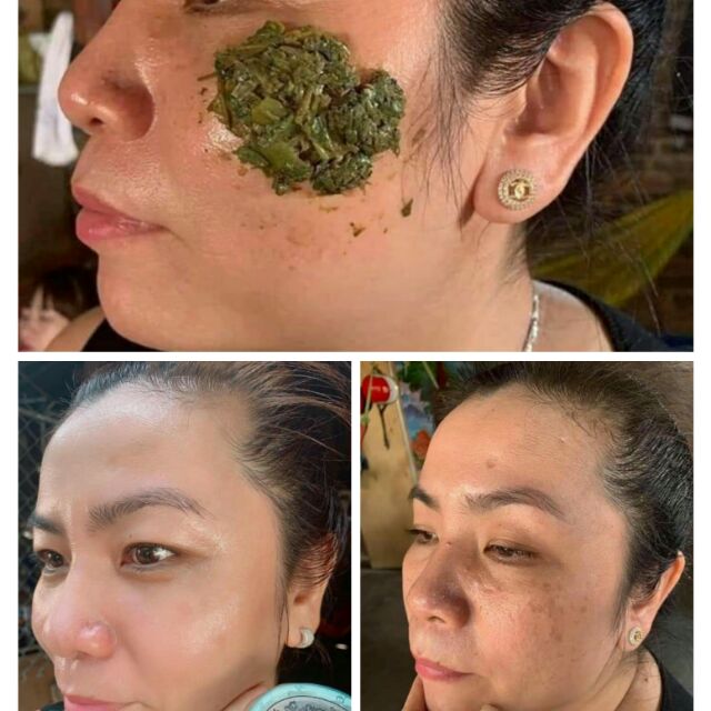 MỠ TRĂN N'STORE có rất nhiều công dụng. Đặc biệt HỖ TRỢ TRỊ NÁM đang là công dụng hàng đầu được chị em phụ nữa biết đến.