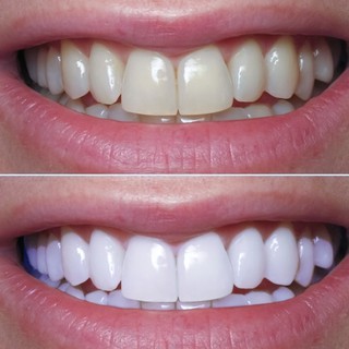 Kem Đánh Trắng Răng Eucryl Toothpaste