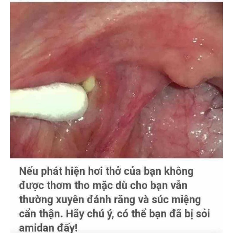 Viêm họng, viêm amidam ông cụ làng nghè