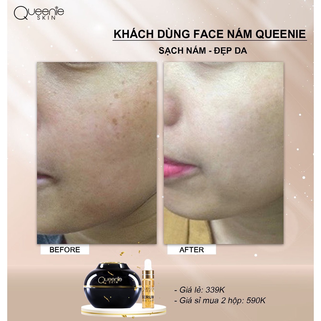 Tặng serum dưỡng kem giảm nám tàn nhang dưỡng trắng da mờ thâm sạm chống - ảnh sản phẩm 5