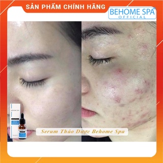 Serum mụn thảo dược Behome spa