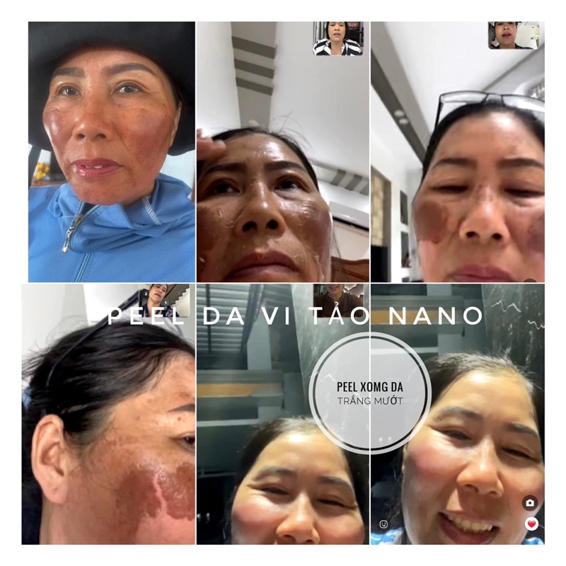 PEEL DA VI TẢO NANO GIÚP LOẠI BỎ LÀN DA KHÔ XẠM TRỞ NÊN MỀM MẠI