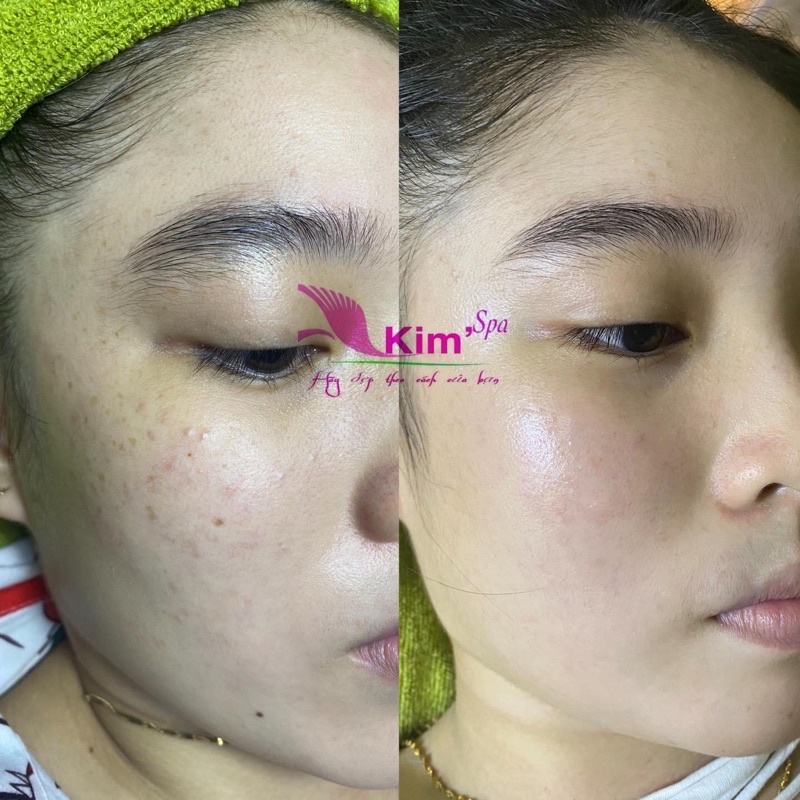 Kem Tái Tạo Da Đông Y Tái Tạo Da Mặt Hiệu Quả Xóa Tan Mụn Nám Tàn Nhang Dành Cho Bạn