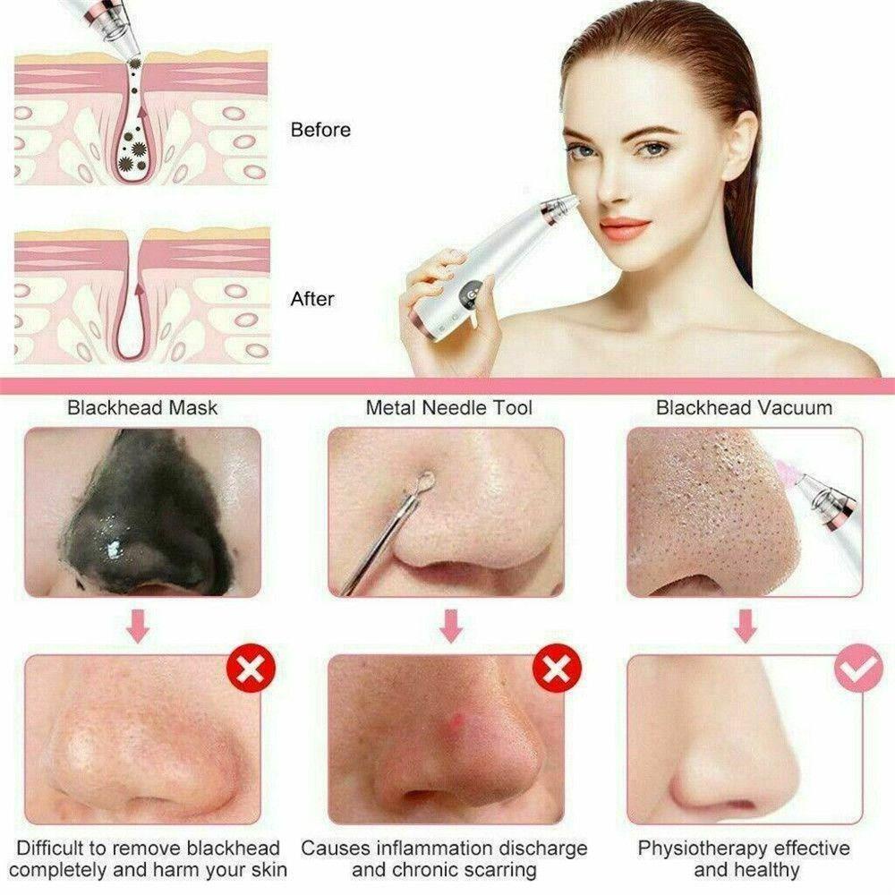 WATTLE Máy Hút Mụn Đầu Đen Làm Sạch Sâu Lỗ Chân Lông