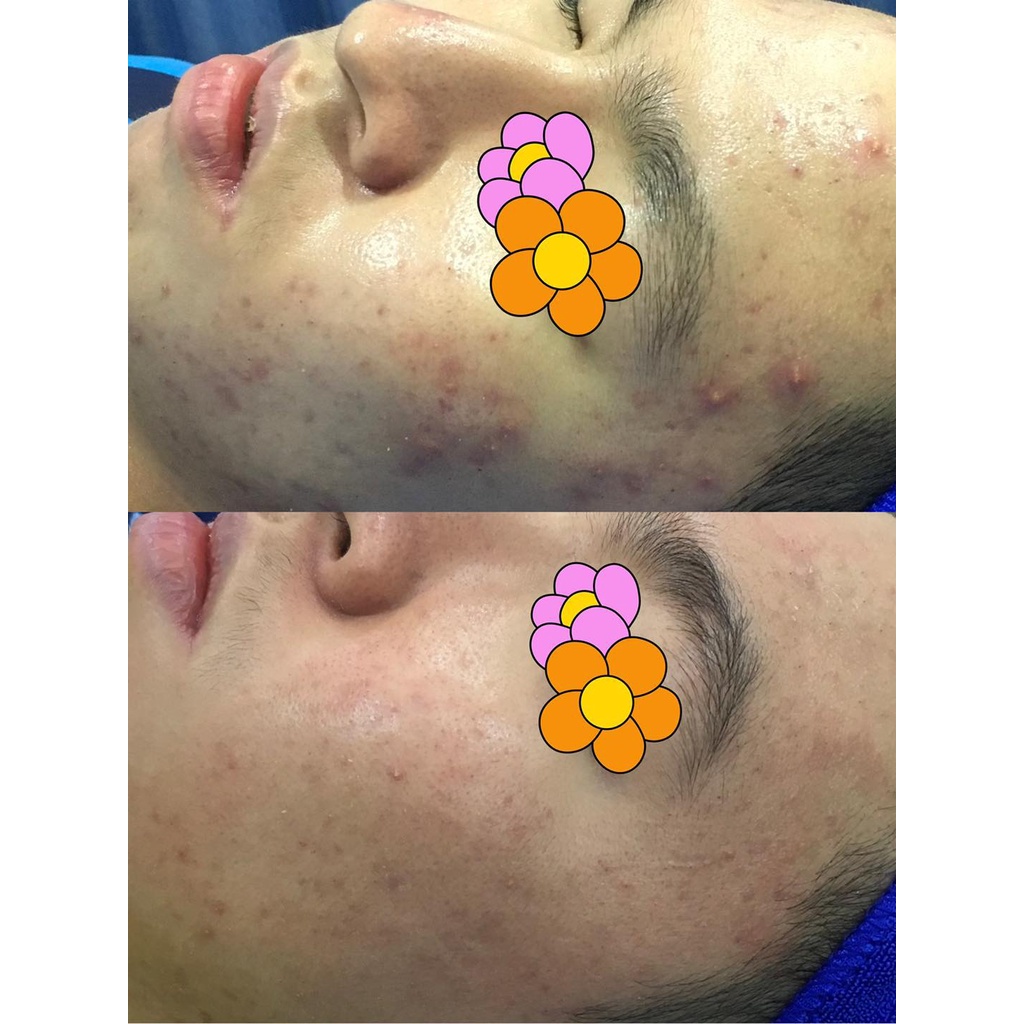 Serum Vitamin A Cho Da Mụn Thâm - Hương Chất Cosmetic