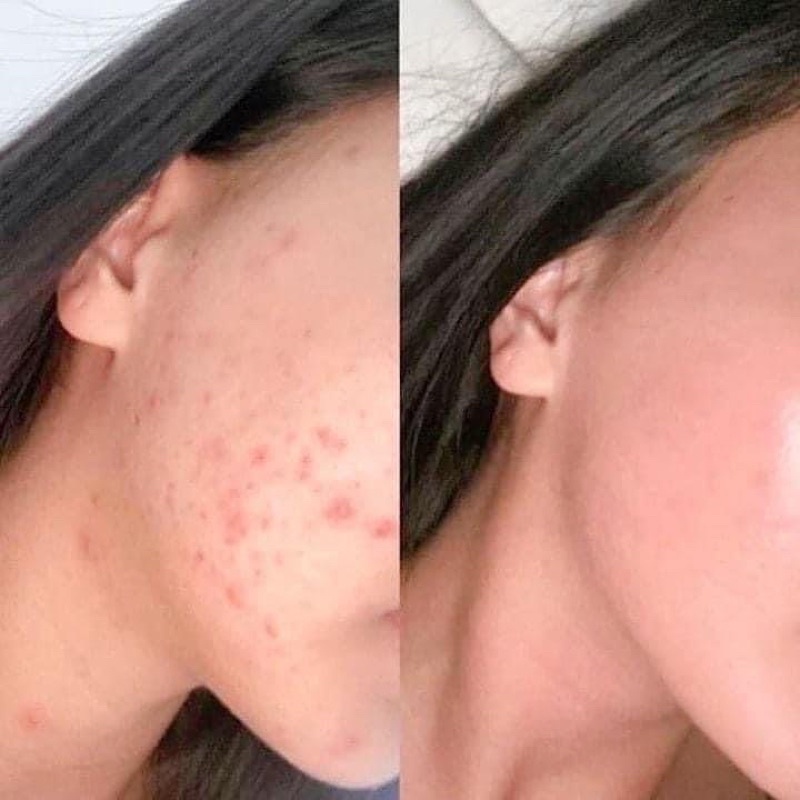 Tẩy tế bào chết PAULA'S CHOICE BHA LIQUID EXFOLIANT 118ml