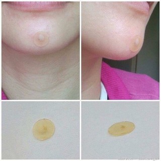 Miếng dán hút mụn Hàn Quốc