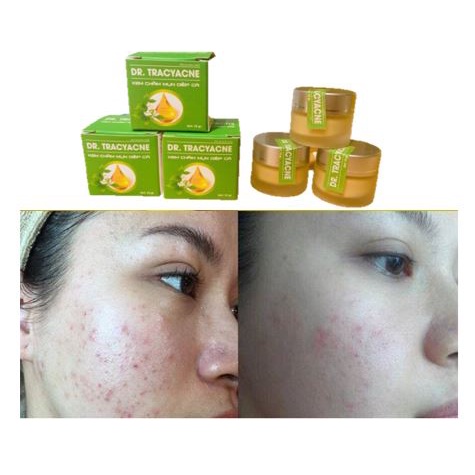 Kem cho da mụn Skinacne - Chiết suất rau má Diếp cá