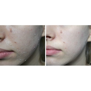 Tẩy da chết Naruko Tree Shine Control and Blemish Clear Peeling Gel