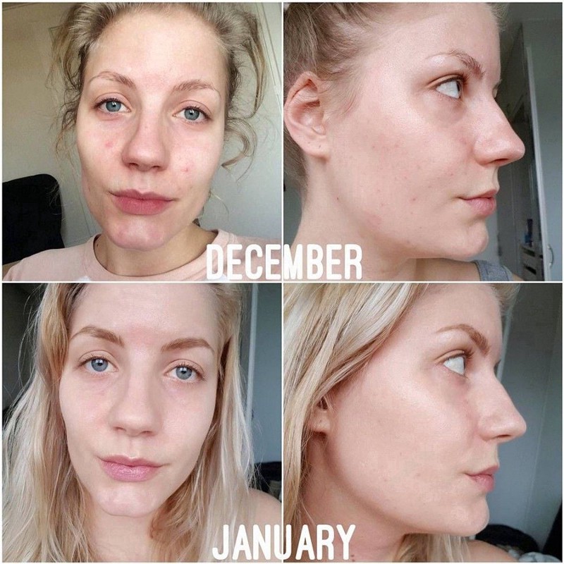 Serum Niacinamide 10% Zinc 1% THE ORDINARY dưỡng da mặt chất lượng cao