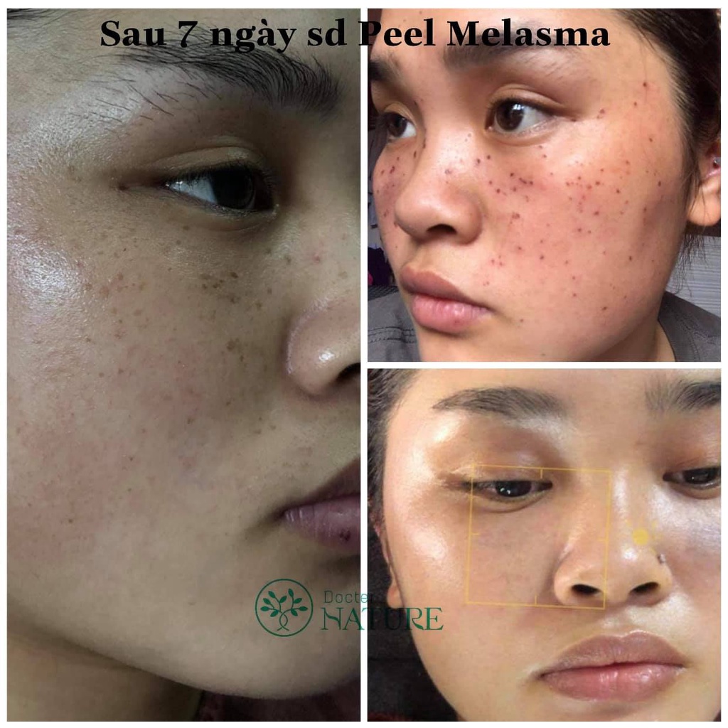 PEEL MELASMA DOCTOR NATURE
