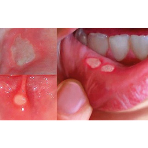 Hỗ trợ giảm nhiệt miệng RED TOMATO hộp 60 viên hỗ trợ thanh nhiệt giải độc gan