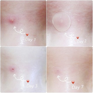 Miếng Dán Mụn Cosrx Acne Pimple Master Patch