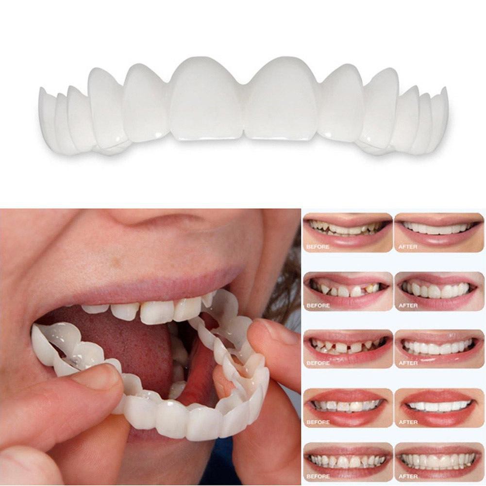 [BÁN CHẠY] Dụng cụ niềng răng tại nhà snapon smile - nẹp răng