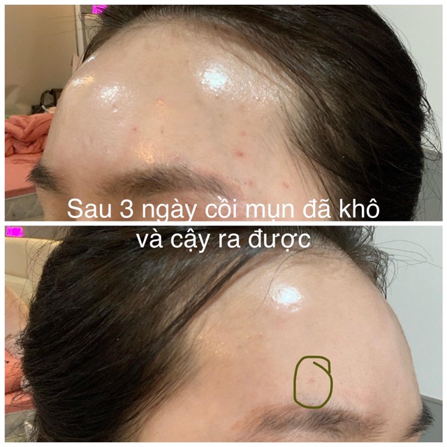 Trị mụn Hemia | BigBuy360 - bigbuy360.vn