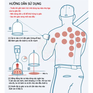 Bộ giác hơi không dùng lửa YGH02
