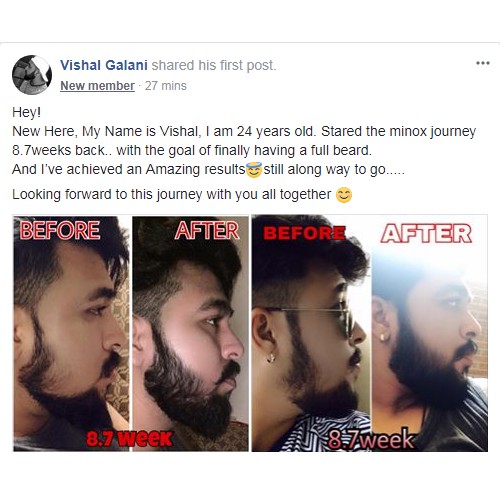 Minoxidil 5% - Dầu duỡng râu tóc - Kích thích mọc râu, nuôi tóc | BigBuy360 - bigbuy360.vn