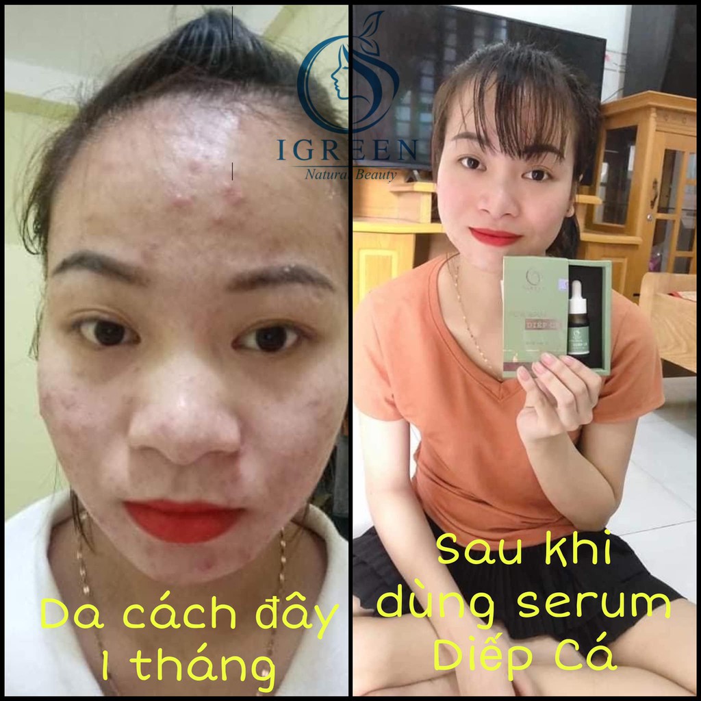 Serum Diếp Cá DIỆT MỤN, GIẢM THÂM, SE KHÍT LỖ CHÂN LÔNG, PHỤC HỒI HƯ TỔN, CĂNG BÓNG, SÁNG DA | BigBuy360 - bigbuy360.vn