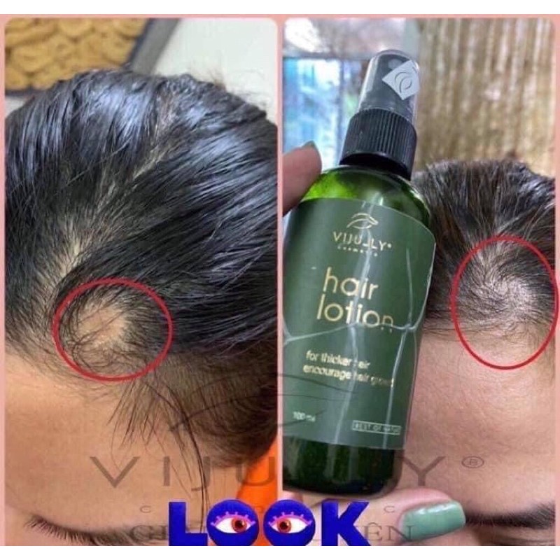 TINH DẦU BƯỞI KÍCH THÍCH MỌC TÓC-GIẢM RỤNG TÓC-KÍCH MỌC TÓC-LÀM DÀI TÓC VIJULLY | BigBuy360 - bigbuy360.vn