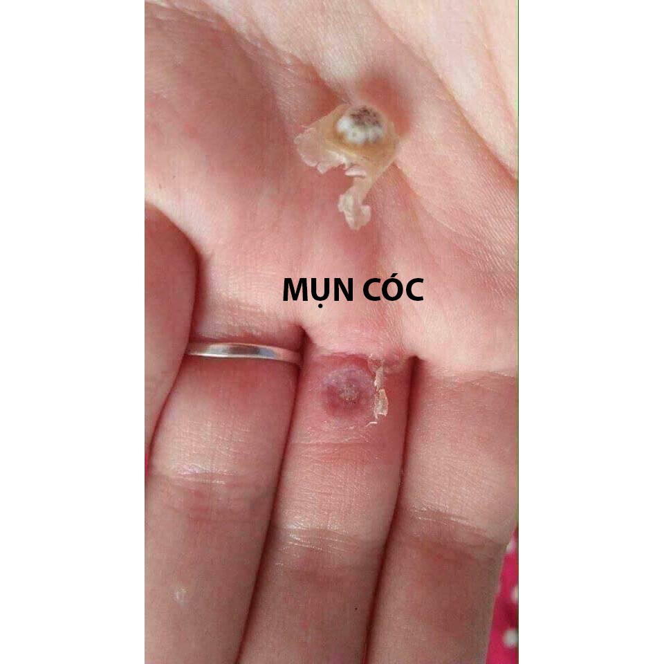 Dung dịch diệt mụn cơm, mụn cóc, sạn cá, mụn thịt của nga, sẵn hàng | BigBuy360 - bigbuy360.vn