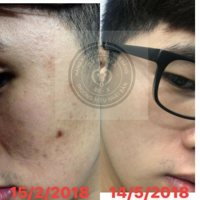 SERUM NGỪA MỤN MỜ THÂM OSHIRMA10gr