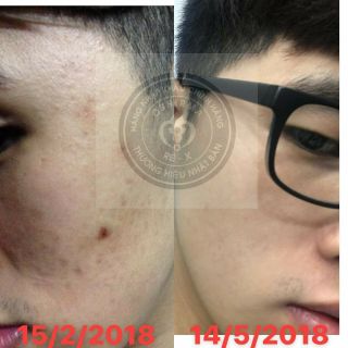 SERUM NGỪA MỤN MỜ THÂM OSHIRMA10gr