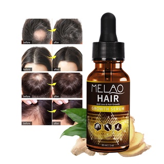 Dung dịch Melao kích thích mọc tóc cấp ấp kiềm dầu dưỡng tóc thoải mái 30ml