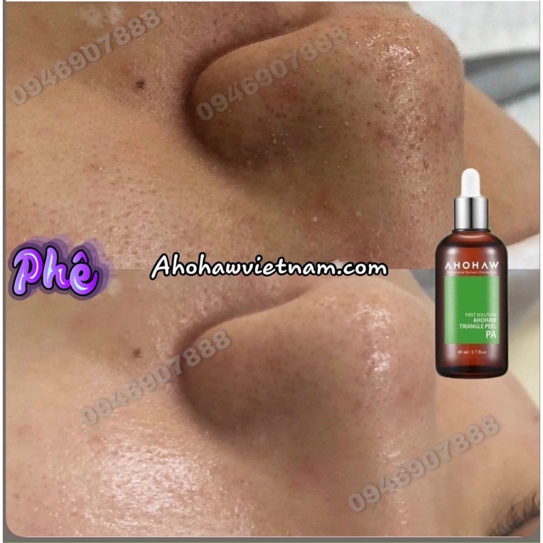 Dung dịch Triangle Peel PA Ahohaw