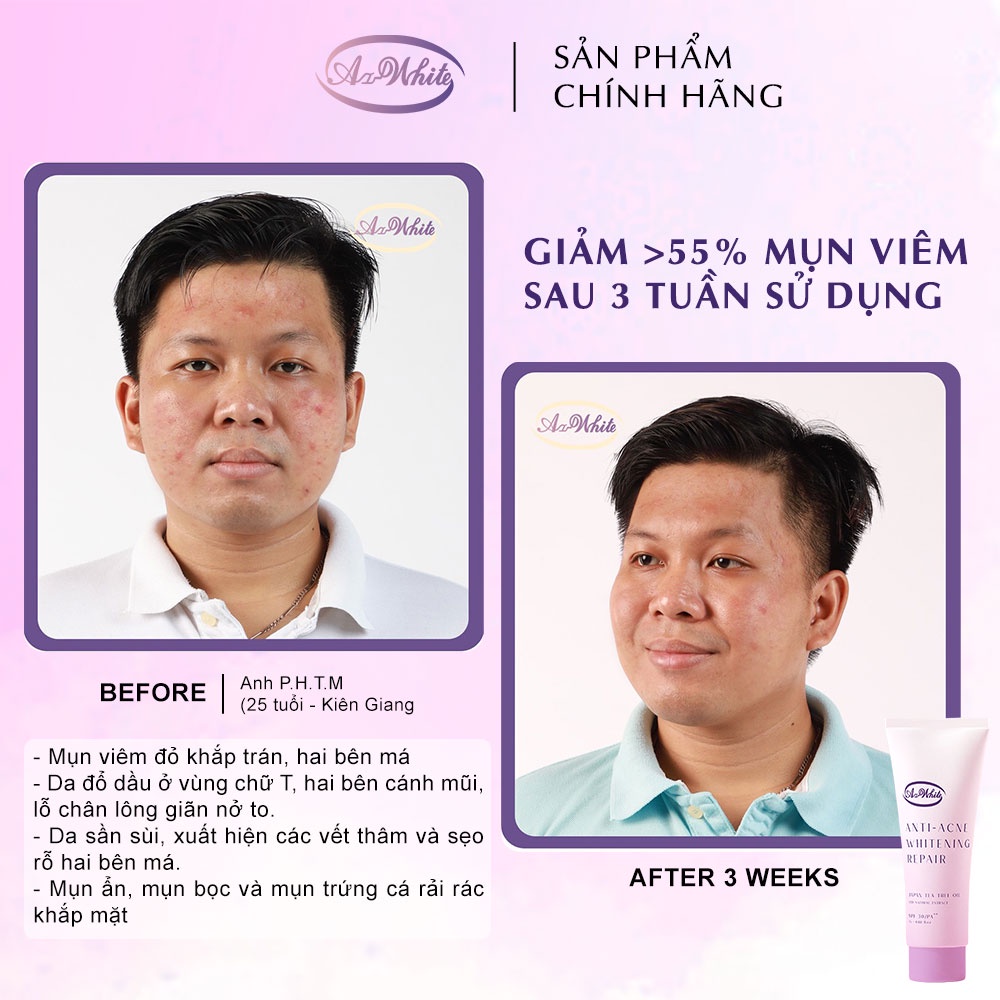 Tuýp Kem Giảm Mụn &amp; Dưỡng Trắng Da A-White 7G