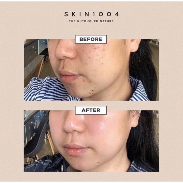 Bộ sản phẩm ngừa mụn SKIN1004 Madagascar Centella