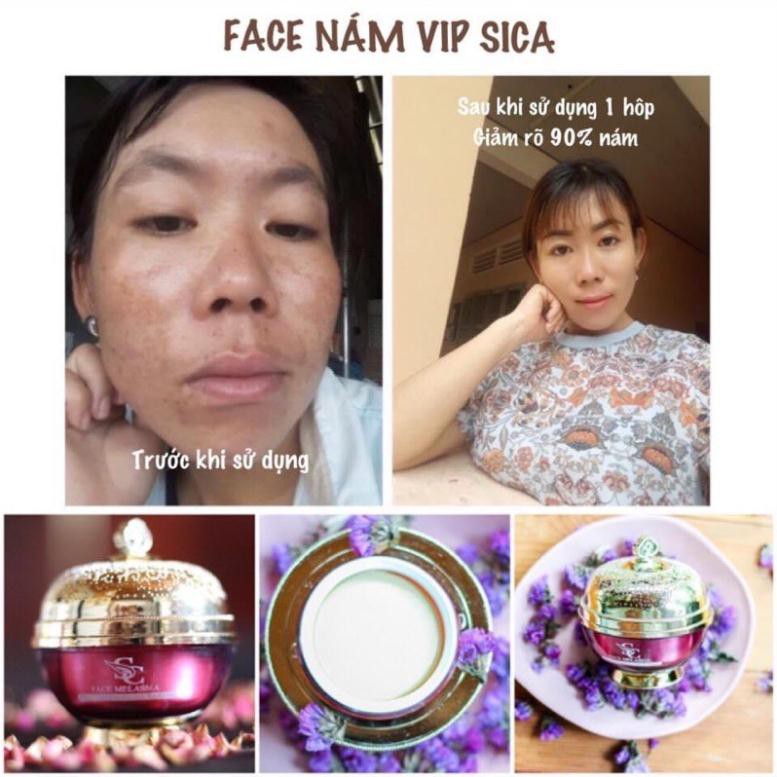 Face Melasma - Kem Nám Vip