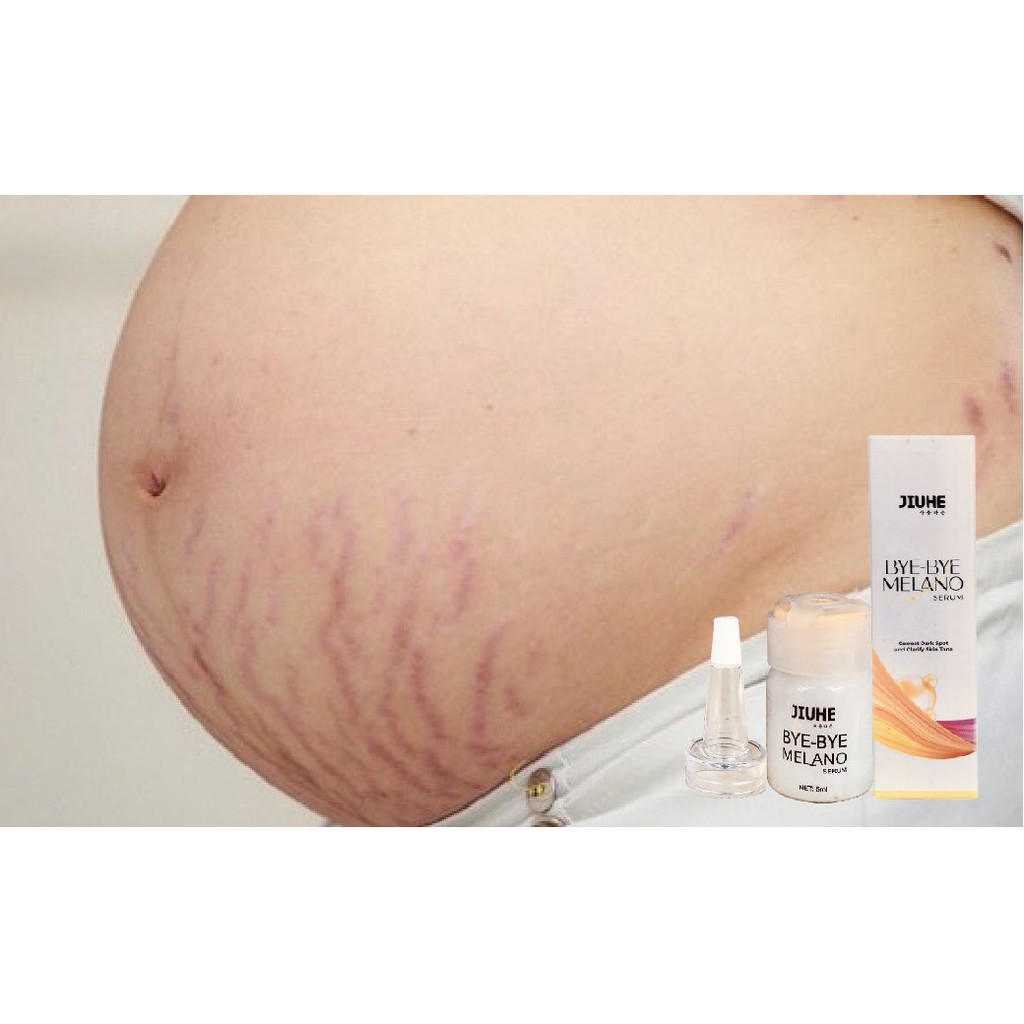 Serum tri thâm hàn quốc JIUHE Q-PEARL giảm thâm do mụn khửu tay chân, thâm sẹo, thâm nách hiệu quả | BigBuy360 - bigbuy360.vn