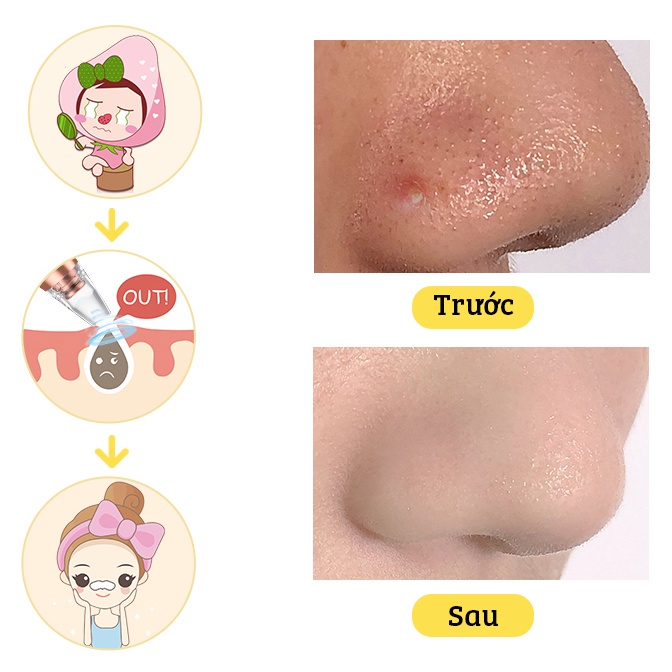 Máy hút mụn cầm tay dụng cụ làm sạch lỗ chân lông giúp hút mụn cám mụn đầu đen cao cấp mẫu mới 2022